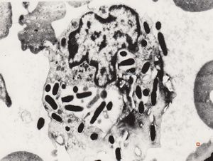 F,43y. | phagocytosed microbes - bacteriaemia